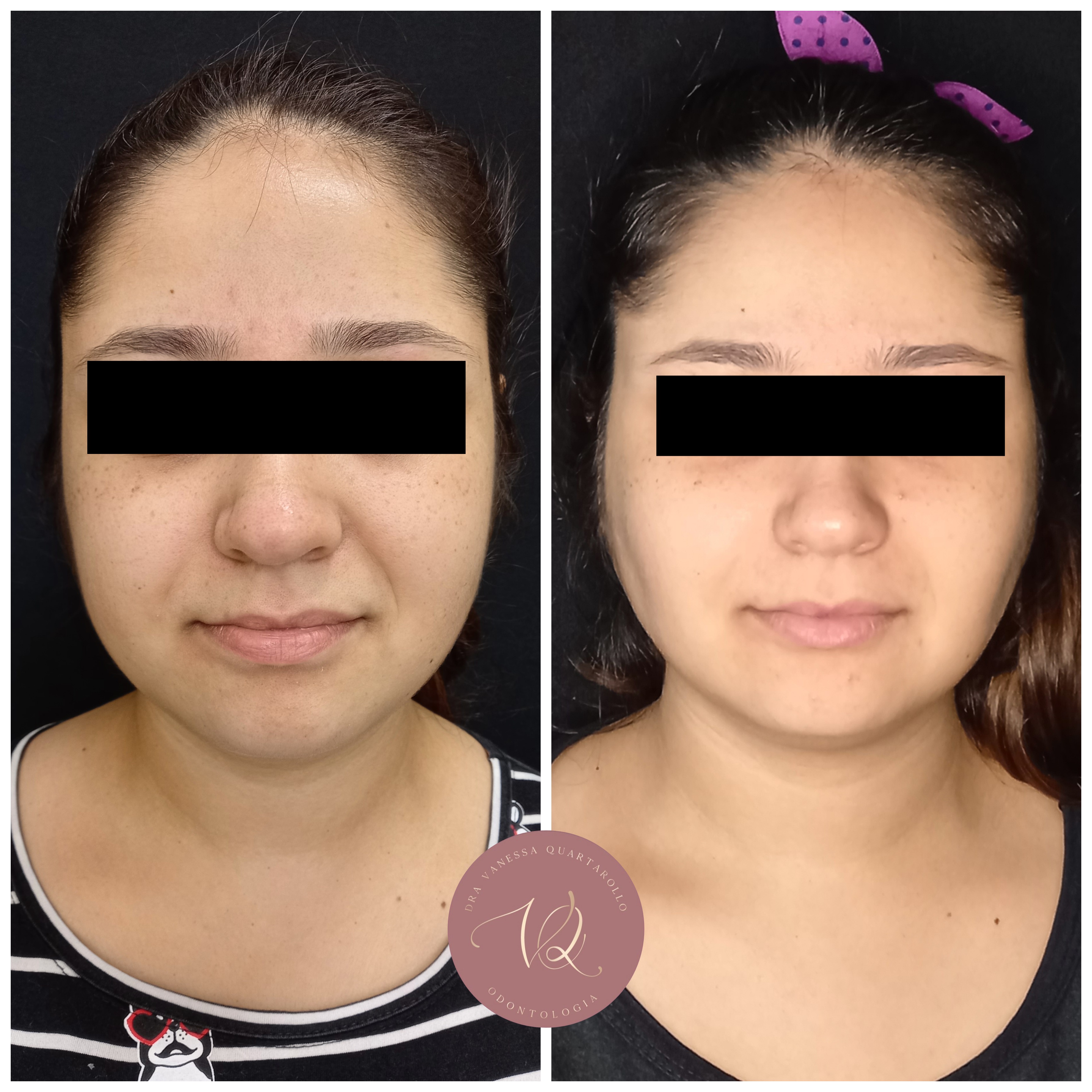 Bichectomia - Antes e Depois