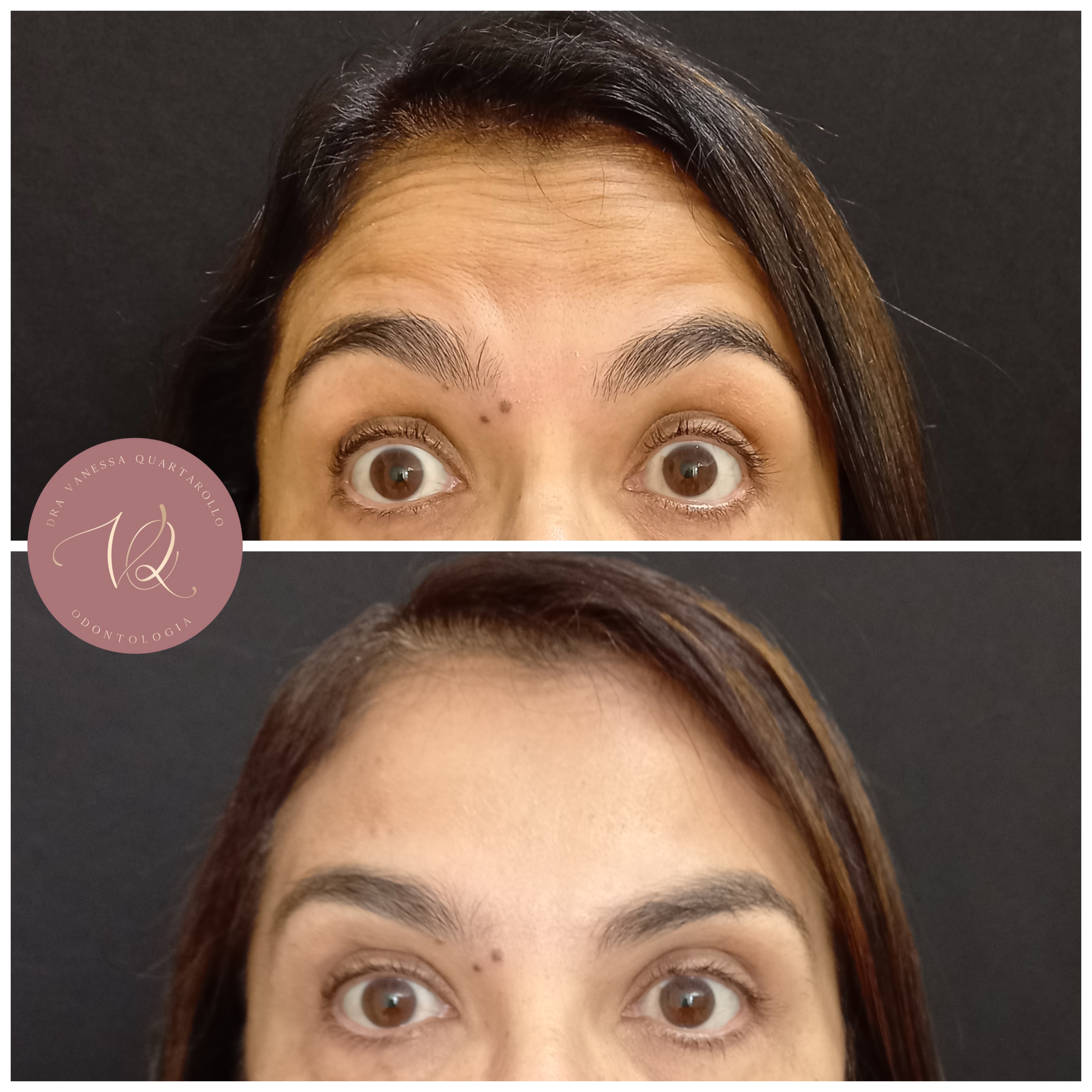 Botox - Antes e depois