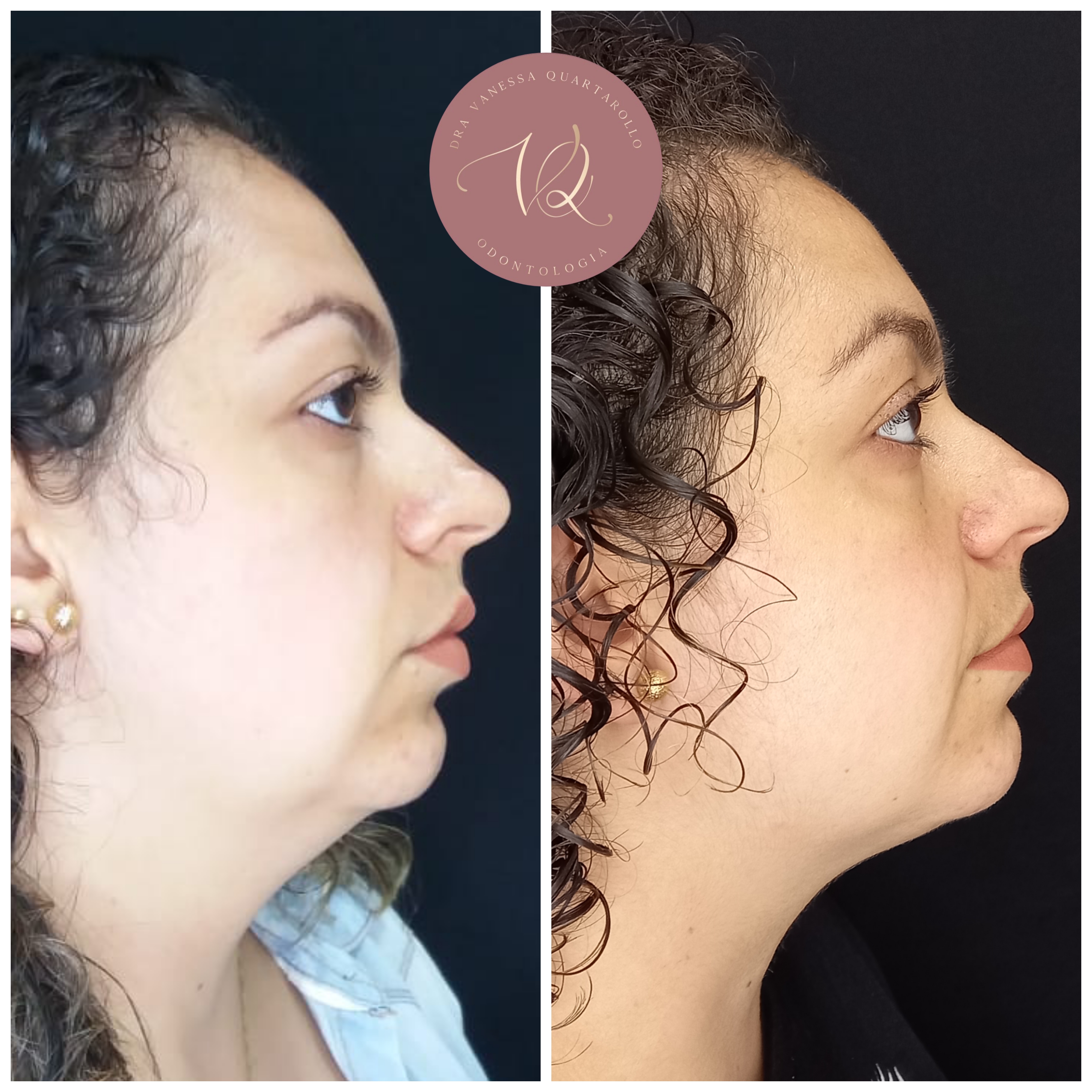 Antes e Depois da Lipo de Papada