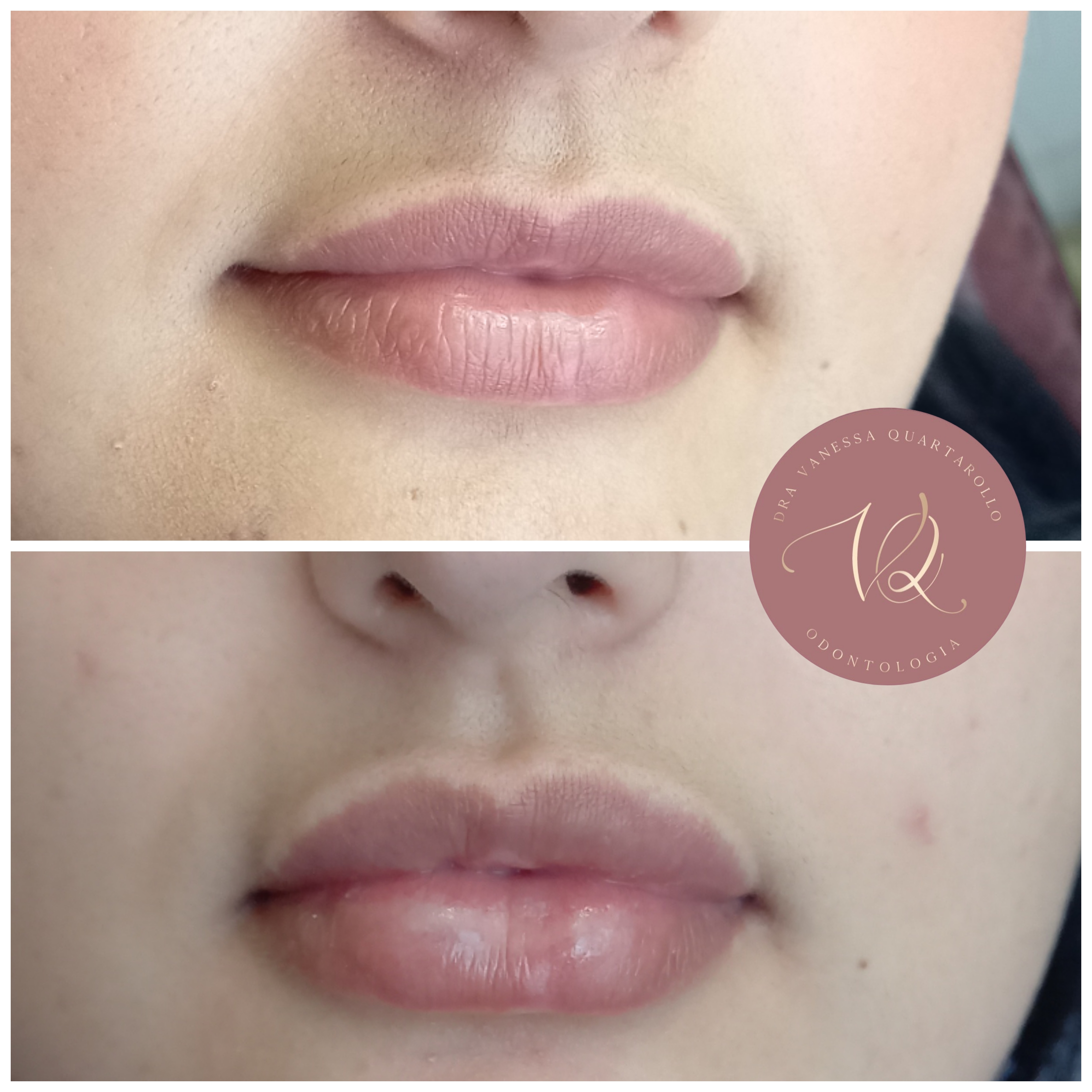 Preenchimento Labial - Antes e depois