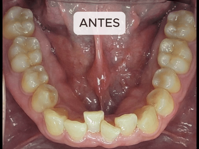 Paciente com Invisalign - Antes e depois