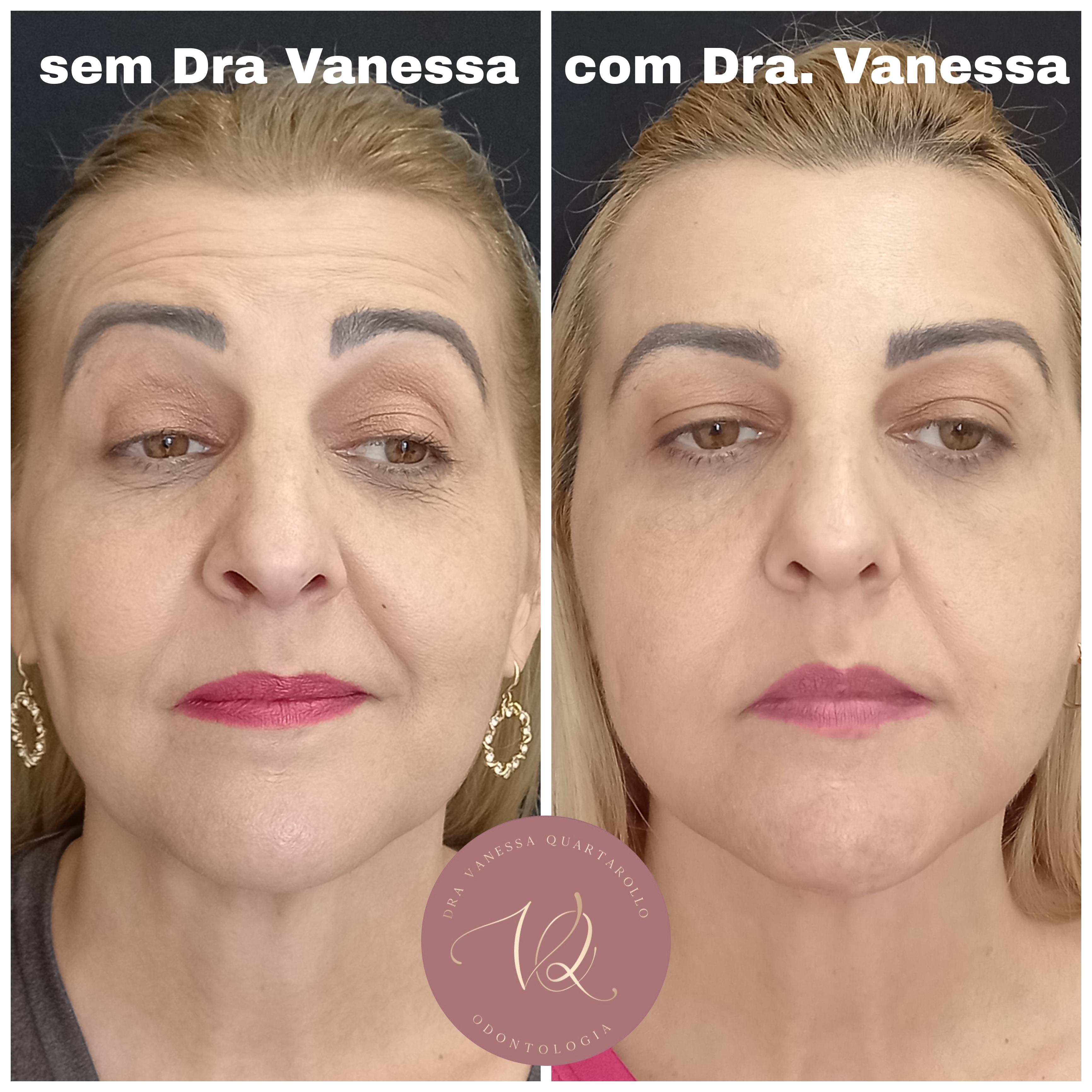 Toxina Botulínica - Antes e depois